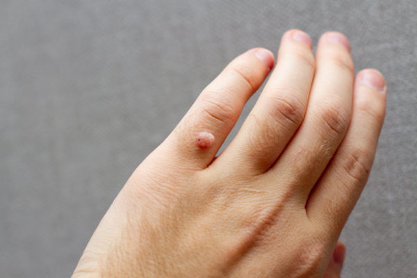 Skąd te kurzajki? Diagnozujemy problem